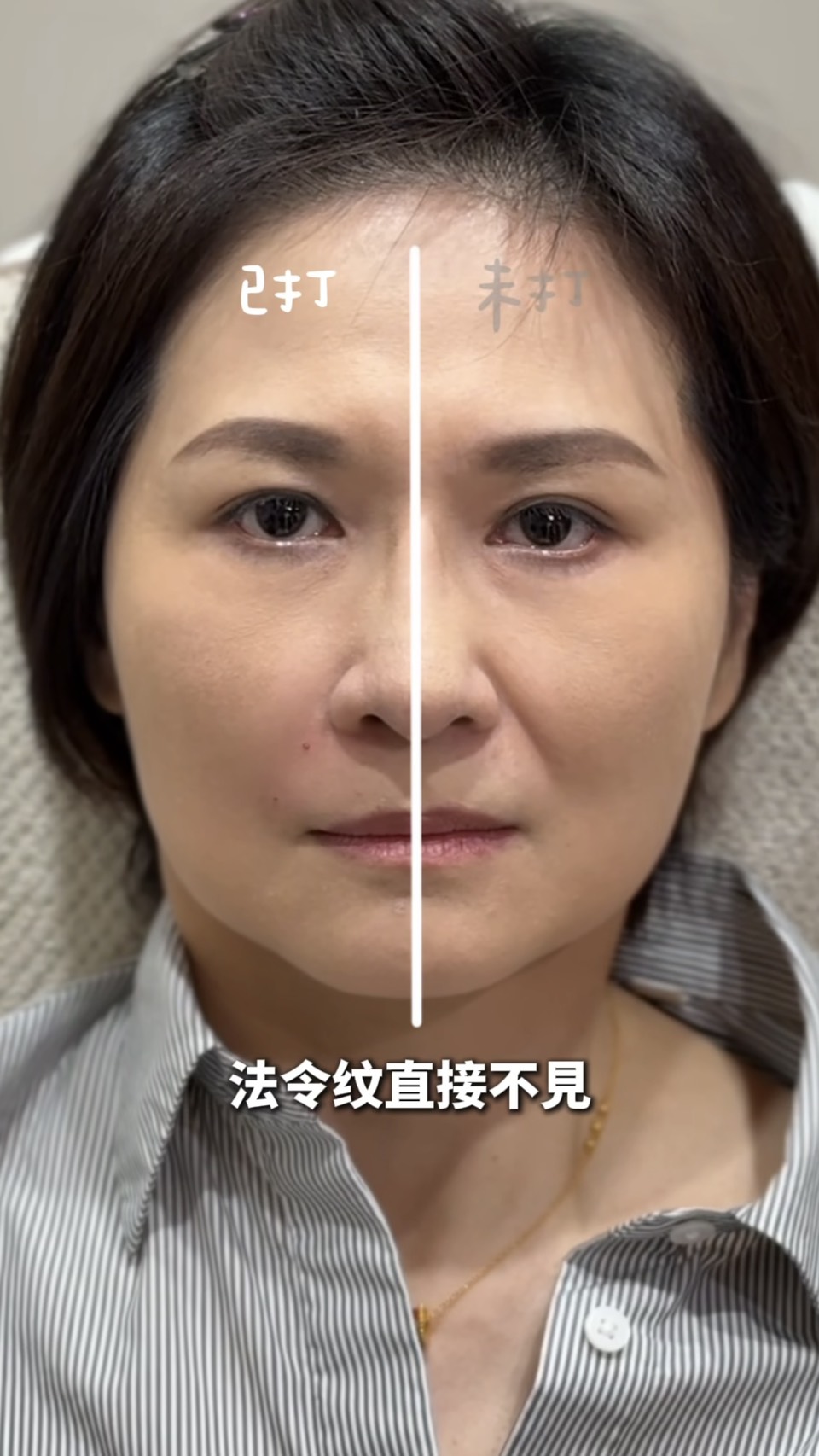 異體真皮粉對比照_下垂型法令紋