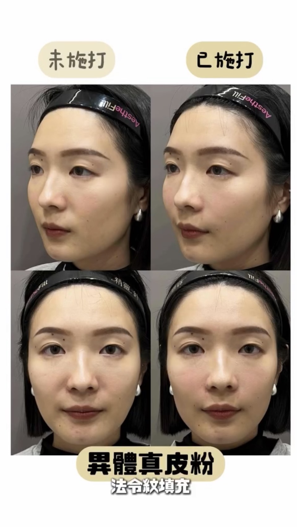 異體真皮粉對比照_凹陷型法令紋