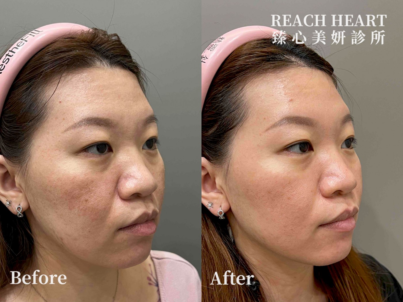 得美微針筆1個月回診_1