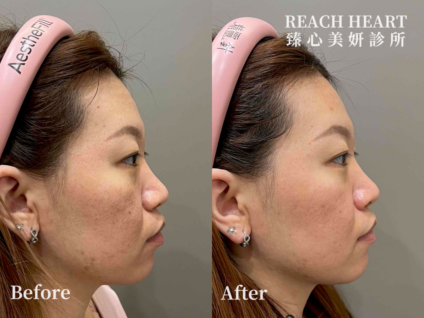 得美微針筆1個月回診_2